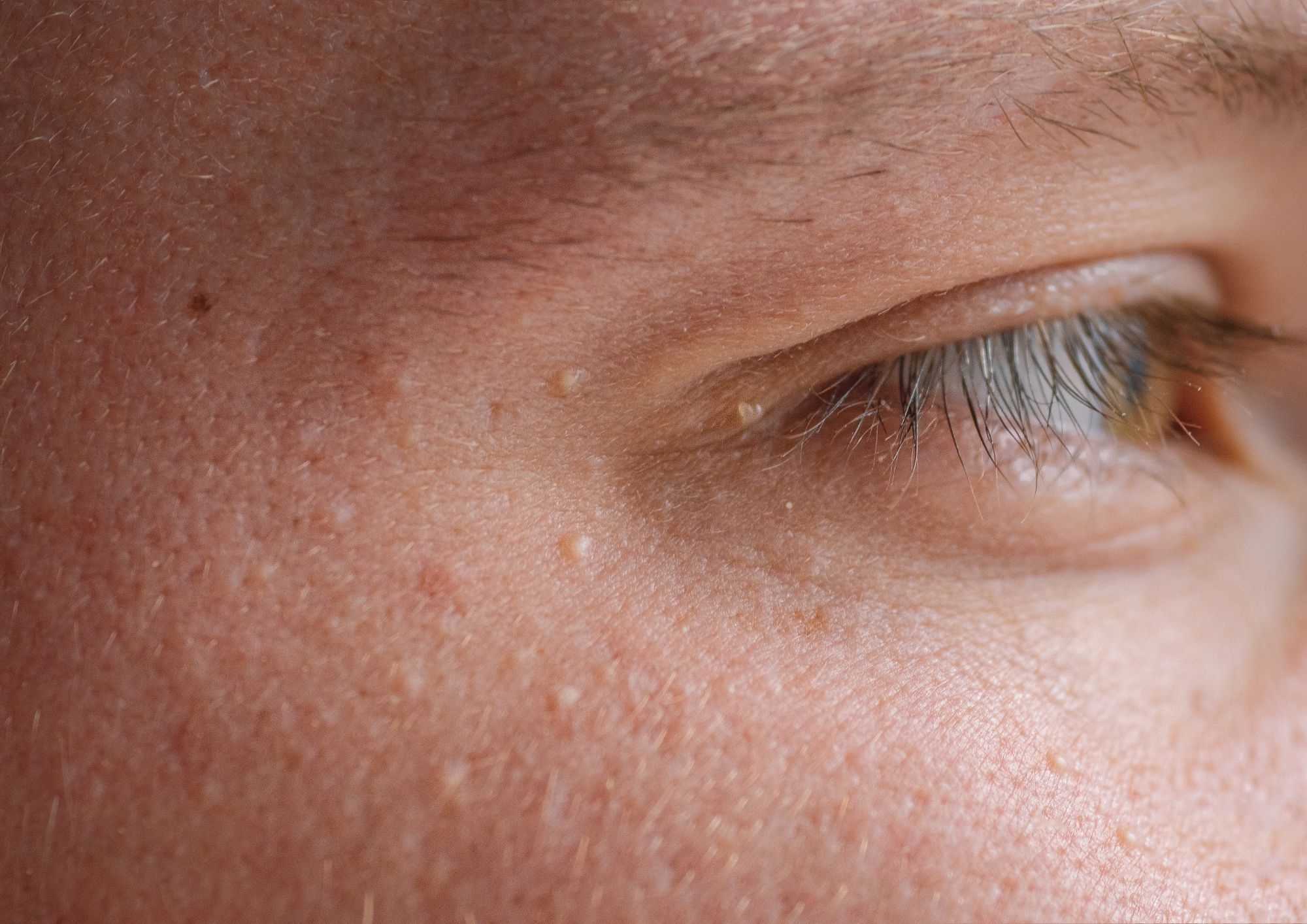 Milia spots on eye Milia spots on eye